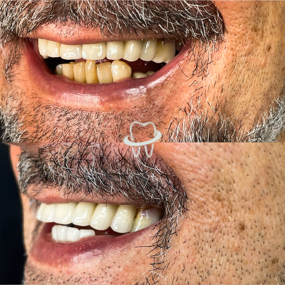 VALE-IMPLANTES-RESULTADOS 02